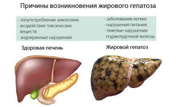 Гепатоз печени: причины, симптомы и лечение 