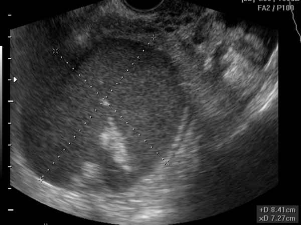 Эндометриоидная киста яичника (левого, правого): беременность, лечение| 