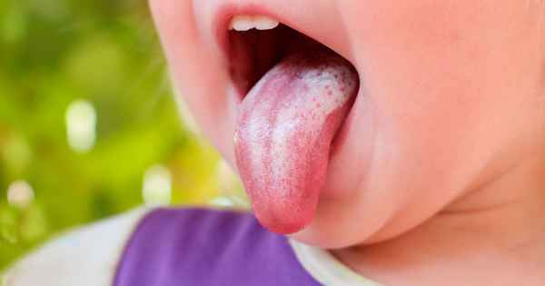 Диагностика и лечение налёта на языке у ребёнка| 