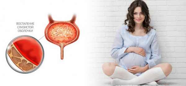 Заболевания при беременности: цистит| 