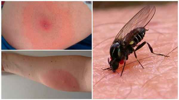 Укус комара: возможные последствия укусов этих вредителей| 