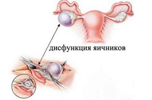 Дисфункция яичников: симптомы, лечение, беременность 