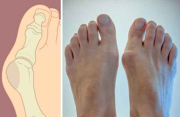 Косточки на ногах лечение, как вылечить косточки на ногах 