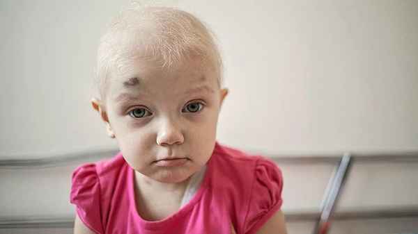 Что такое лейкемия у детей: скрытые признаки лейкоза 