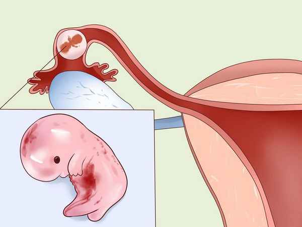 Как забеременеть после внематочной беременности| 