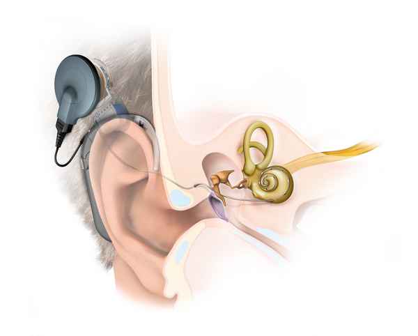 Реабилитация после имплантации: восстановление слуха у детей 