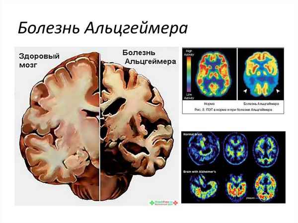 Болезнь Альцгeймера 