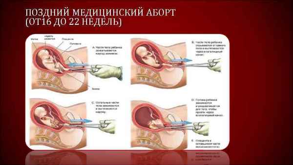 Беременность и роды: ранний выкидыш, осложнения 