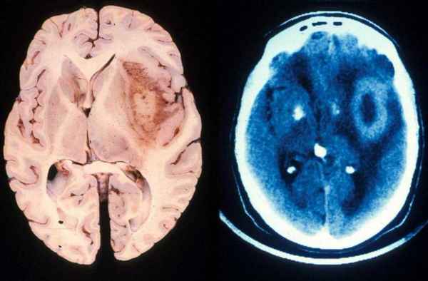 Paк мозга Глиобластома или paк головного мозга 