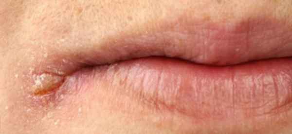 Почему трескаются губы в уголках: обстоятельства появления 