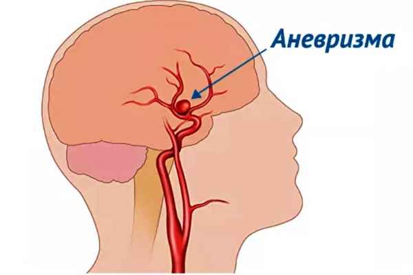 Что такое аневризма головного мозга: симптоматика, причины 