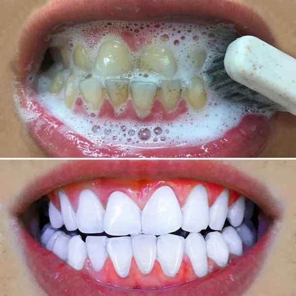 Как отбелить зубы 