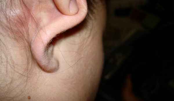 Атерома уха: причины появление на мочке, симптомы, лечение