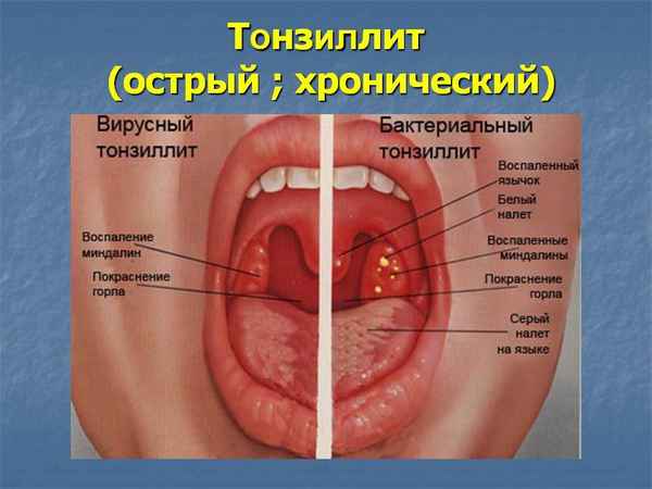 Острый тонзиллит: симптомы и лечение, что это такое, обострения