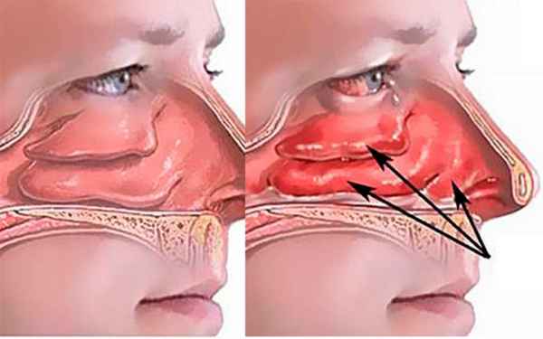 Почему у ребенка заложен нос, как лечить и снять сильную заложенность