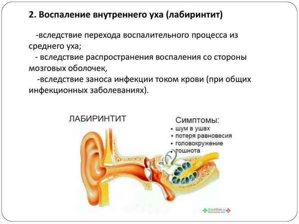 Внутренний отит: симптомы воспаления внутреннего уха, лечение
